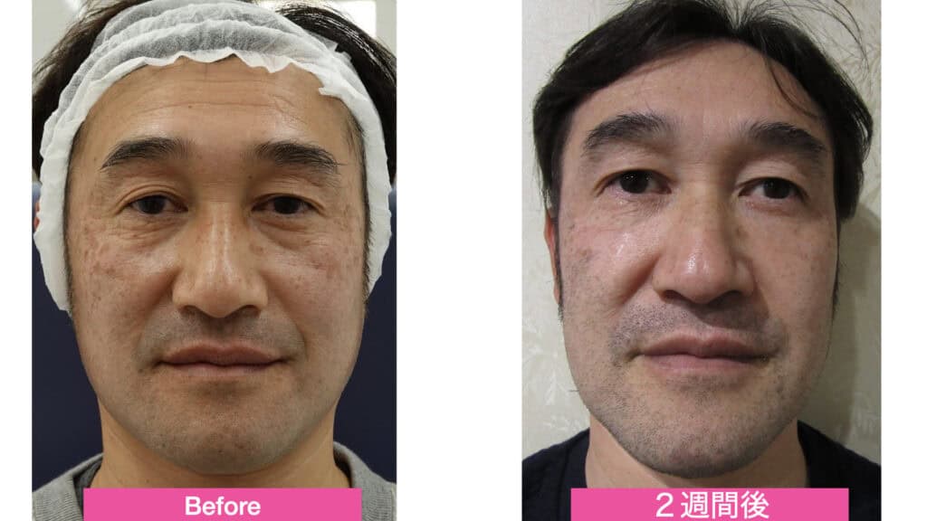 肌のシミ・くすみ改善 白無垢ピーリングで若見え肌へ.